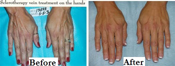 Sclerotherapy Hands Before After Label