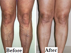 Varicose Veins Legs Before After Label