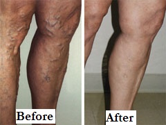Vericose Veins Side Before After Label