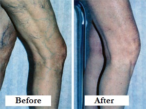 Spider vein treatment before and after pic